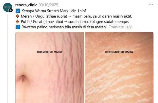 warna stretch mark