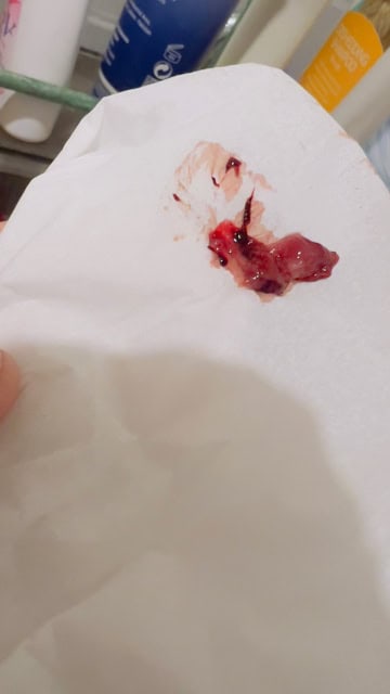 gambar darah keguguran 1 minggu
